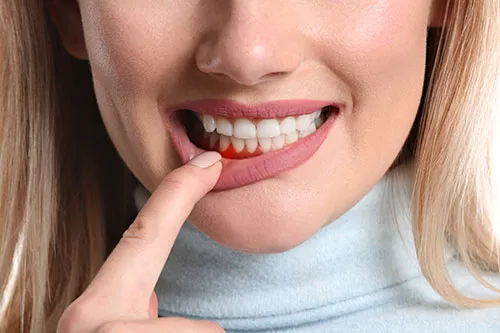 woman pointing at her gums